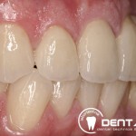 Herausnehmbarer Zahnersatz