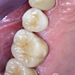 Festsitzender Zahnersatz