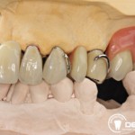 Festsitzender Zahnersatz