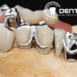 Festsitzender Zahnersatz