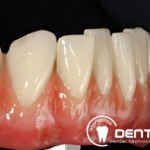 Festsitzender Zahnersatz