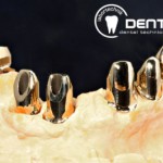 Festsitzender Zahnersatz