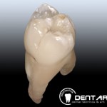 Festsitzender Zahnersatz