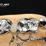 Festsitzender Zahnersatz