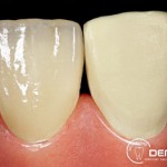 Herausnehmbarer Zahnersatz