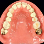 Herausnehmbarer Zahnersatz