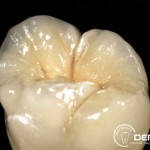 Herausnehmbarer Zahnersatz