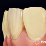 Herausnehmbarer Zahnersatz