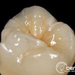 Herausnehmbarer Zahnersatz