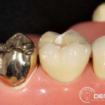 Herausnehmbarer Zahnersatz