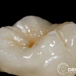 Herausnehmbarer Zahnersatz