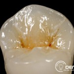 Herausnehmbarer Zahnersatz