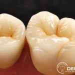 Herausnehmbarer Zahnersatz