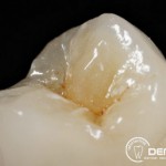 Herausnehmbarer Zahnersatz